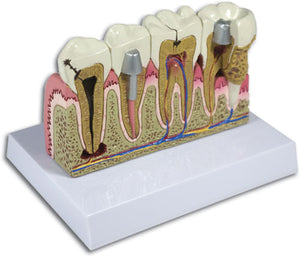 Diseased Tooth Model