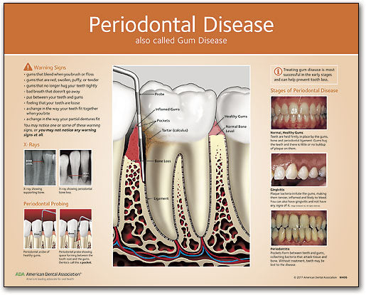 Periodontal Disease Chart