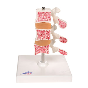3B Osteoporosis Anatomical Model (3 Vertebrae)