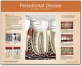 Periodontal Disease Chart