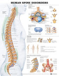 The Human Spine Disorders Anatomical Chart (50 x 61cm)