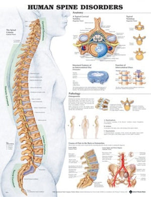 The Human Spine Disorders Anatomical Chart (50 x 61cm)