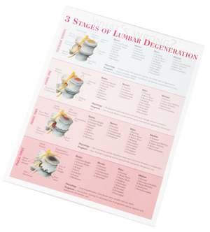 3 Stages of Lumbar Degeneration Handout