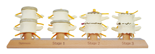 3 Stage Spinal Degeneration Model