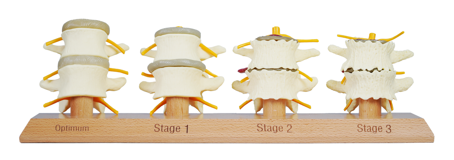 3 Stage Spinal Degeneration Model