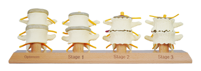 3 Stage Spinal Degeneration Model