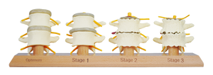 3 Stage Spinal Degeneration Model