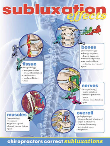 Vertebral Sublux Effects Poster (18" x 24")