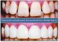 Before and After Veneer Postcard