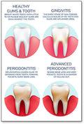 Gum Health Wall Art Poster