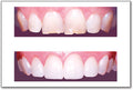 Veneers Poster