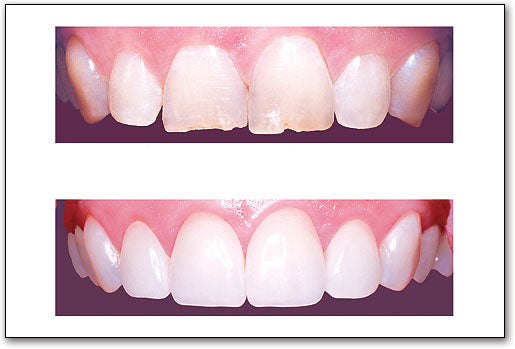 Veneers Poster