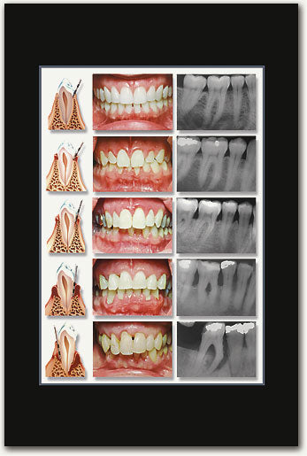 Stages of Perio Poster