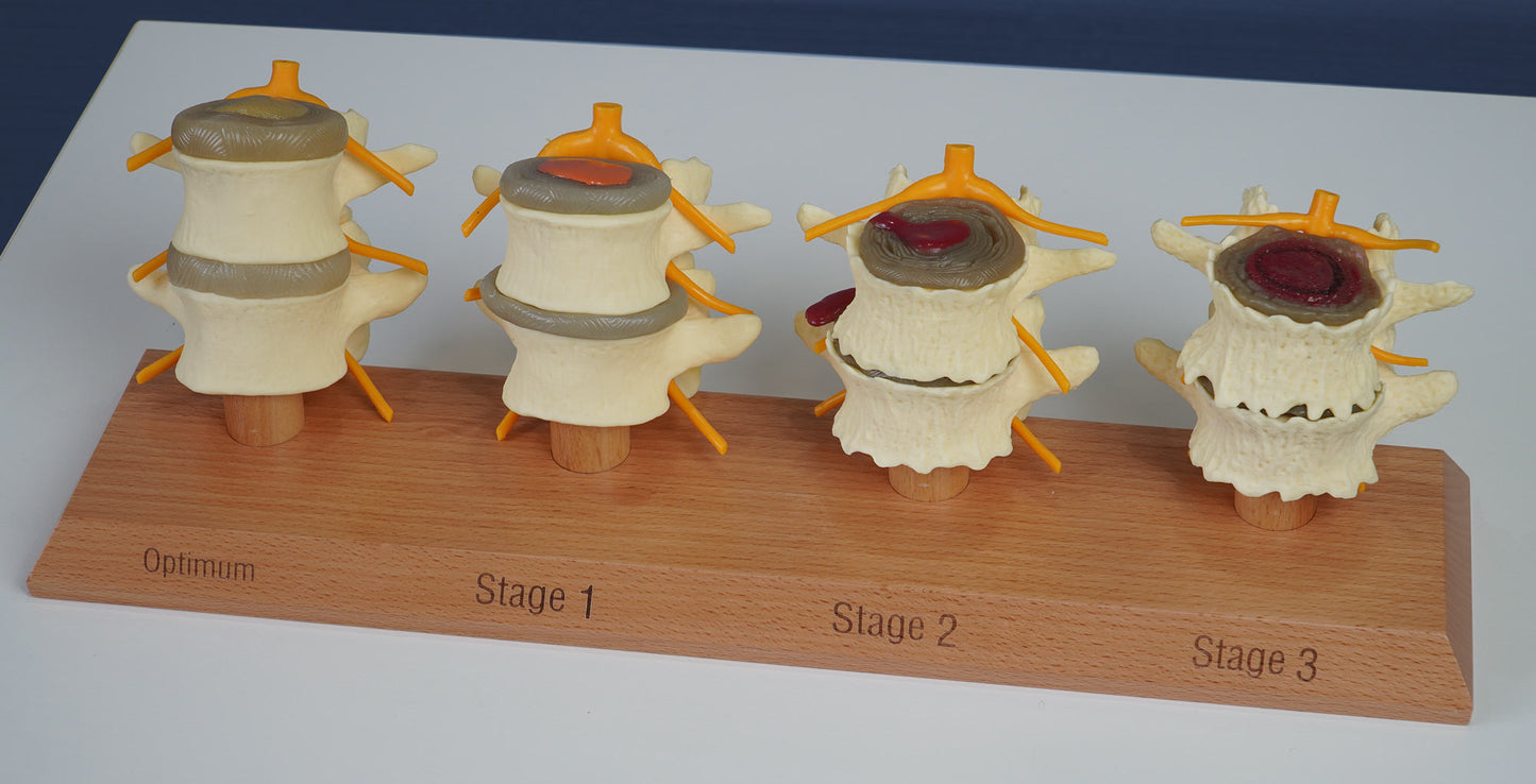 3 Stage Spinal Degeneration Model