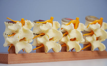 3 Stage Spinal Degeneration Model