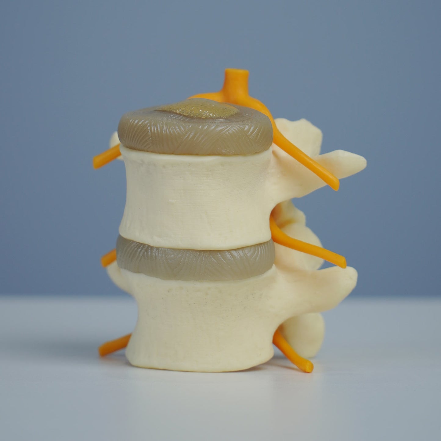 3 Stage Spinal Degeneration Model