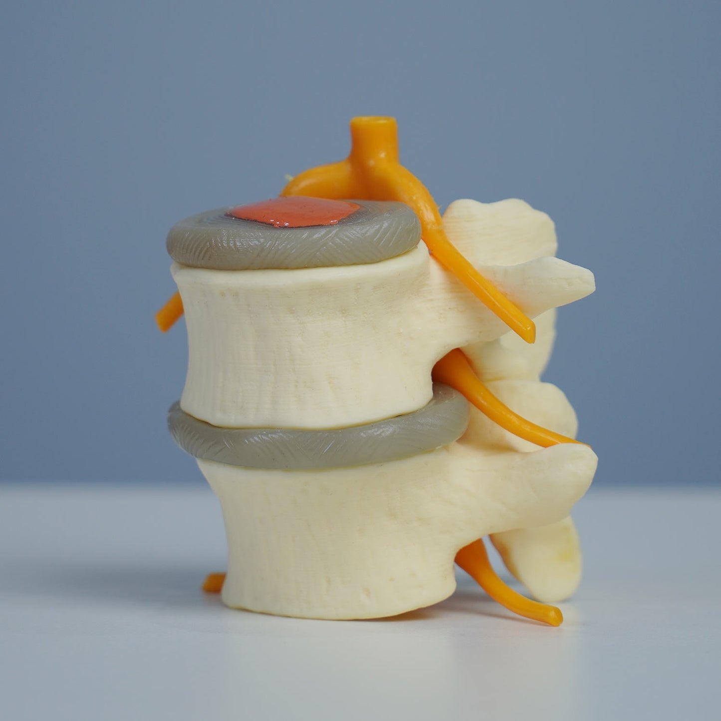 3 Stage Spinal Degeneration Model