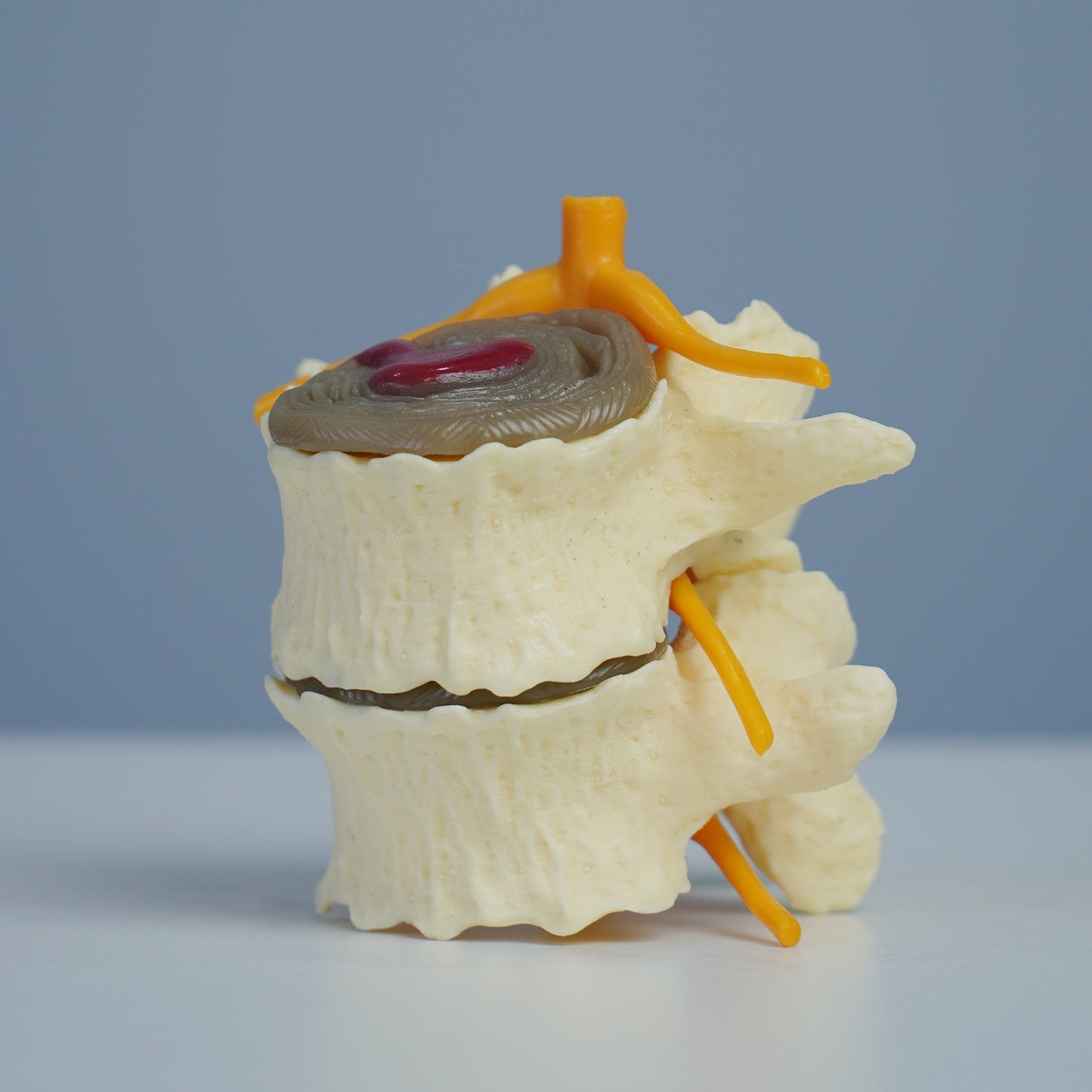 3 Stage Spinal Degeneration Model
