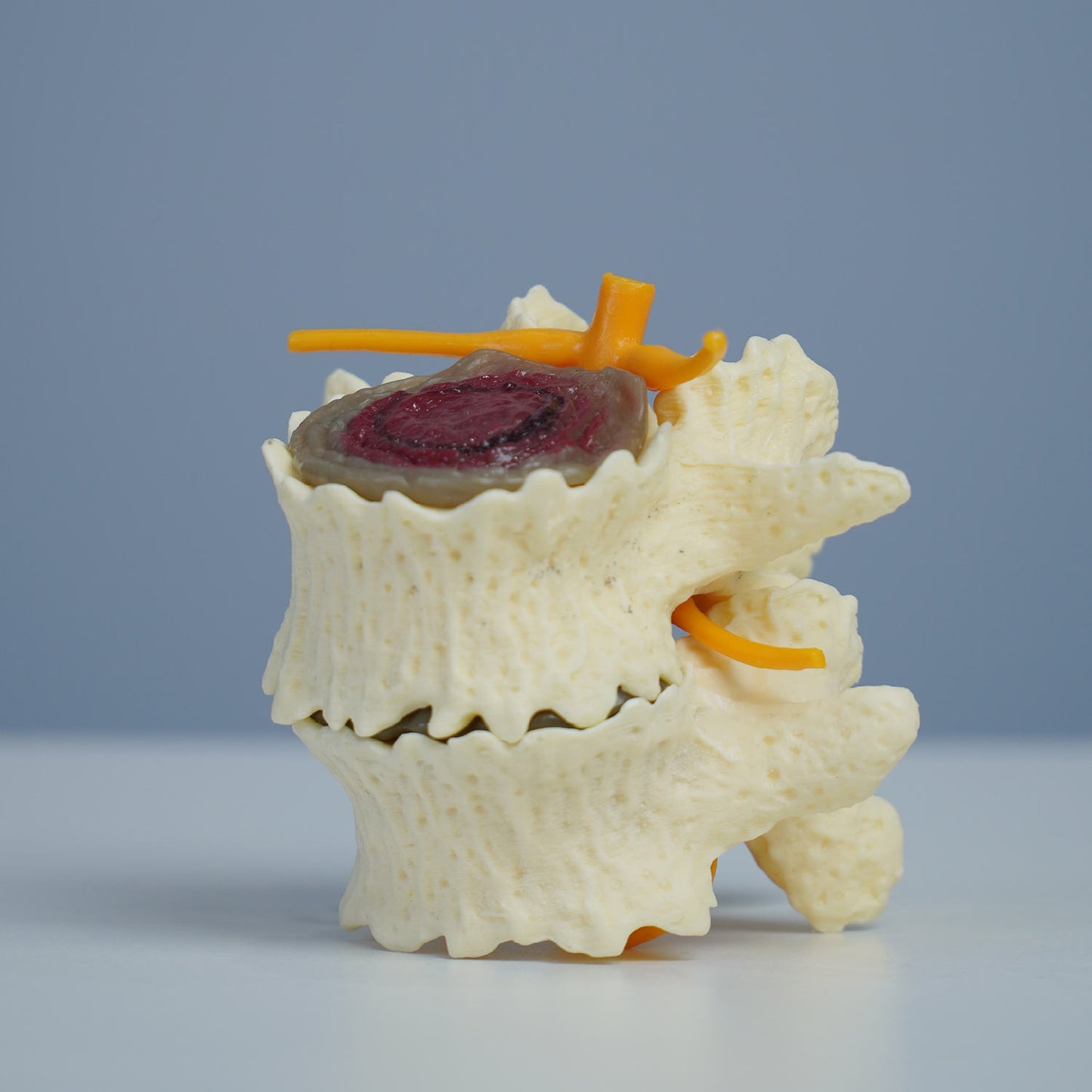 3 Stage Spinal Degeneration Model