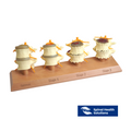 3 Stage Spinal Degeneration Model