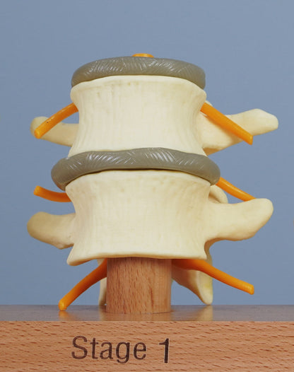 3 Stage Spinal Degeneration Model