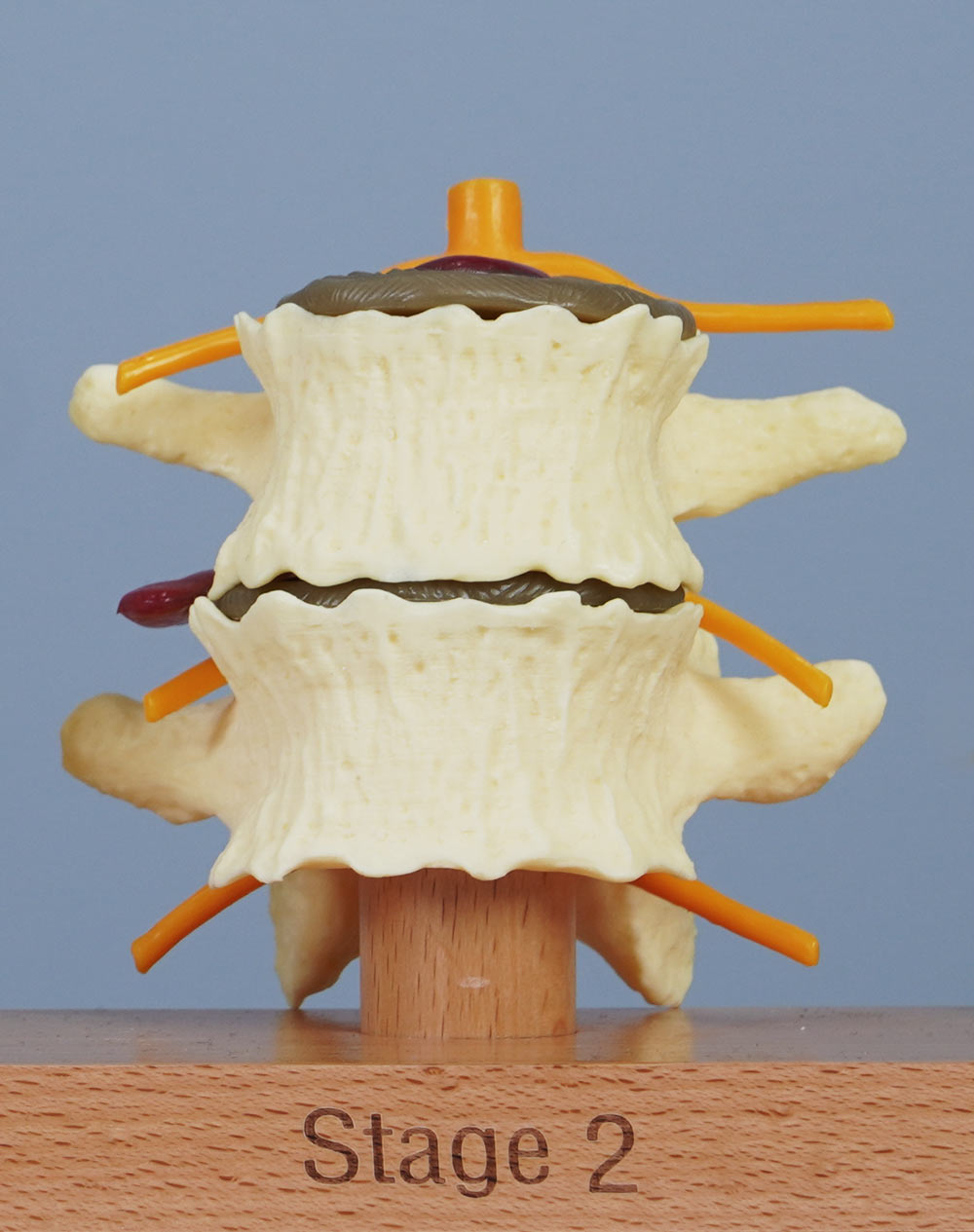 3 Stage Spinal Degeneration Model
