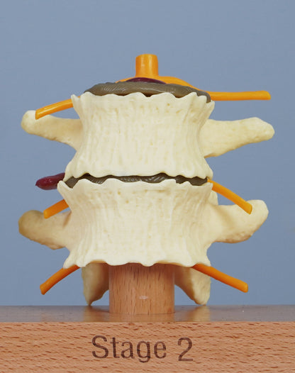 3 Stage Spinal Degeneration Model