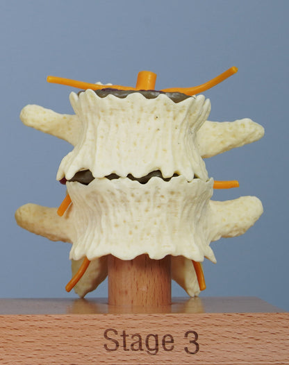 3 Stage Spinal Degeneration Model