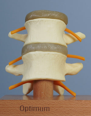 3 Stage Spinal Degeneration Model